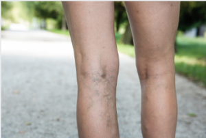 Odyssey varicose vein treatment Adelaide